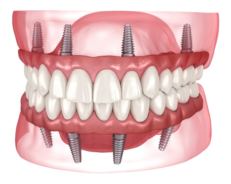 Benefits of Teeth-In-A-Day, Toronto Dentist