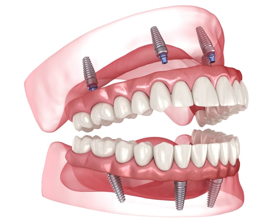 All-on-4 Dental Implants Process, Toronto Dentist