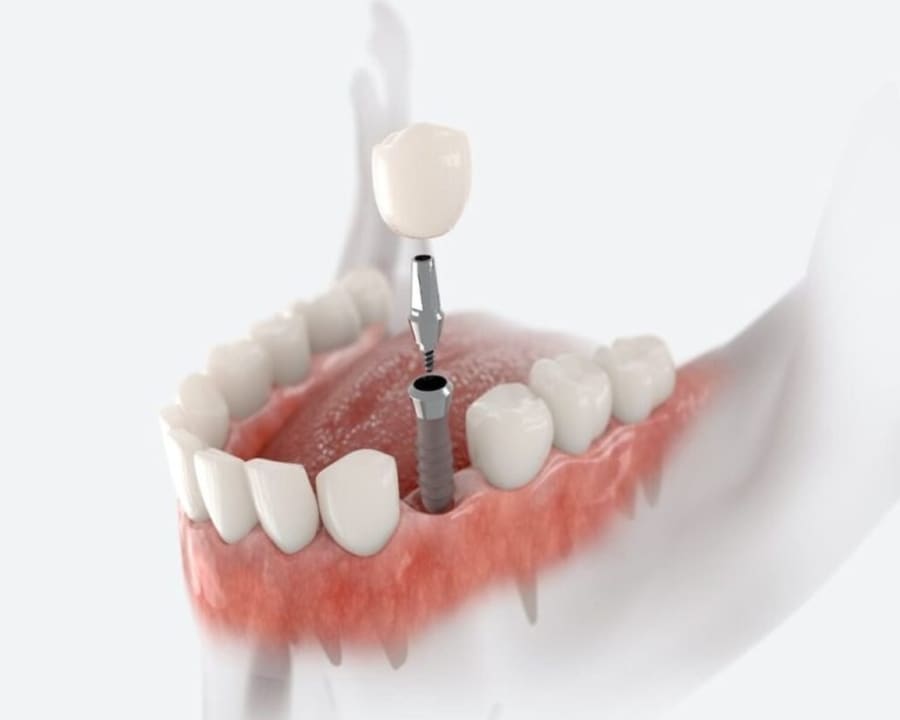 Dental Implants, Toronto Dentist