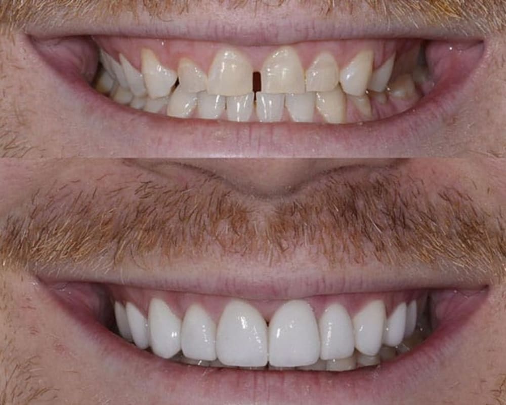 Benefits of Non-Prep Veneers | Toronto Dentist