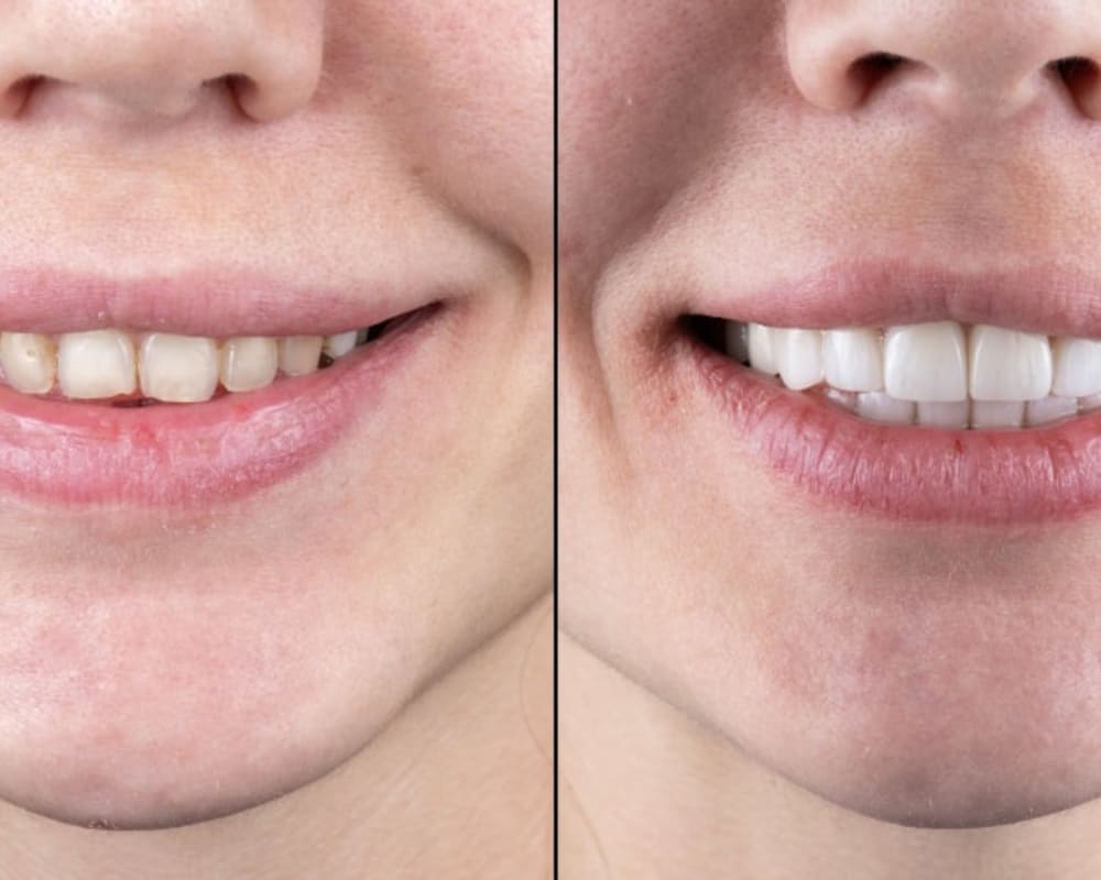 What to Expect During the Non-Prep Veneers Procedure | Toronto Dentist