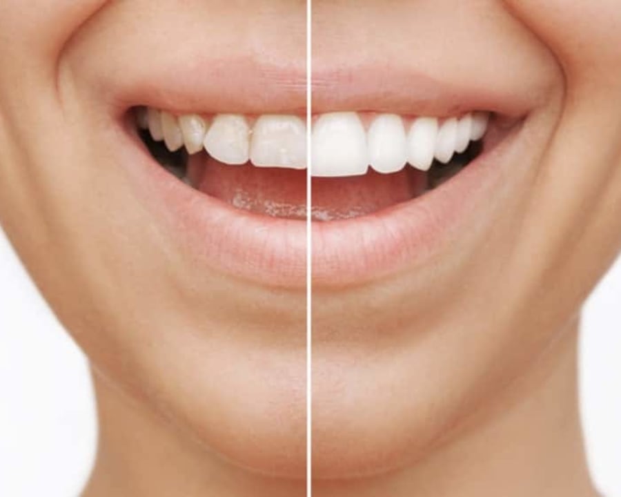 Steps of the Veneers Procedure, Toronto Dentist