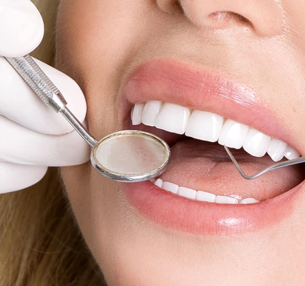 Cost comparison chart for porcelain veneers in Canada