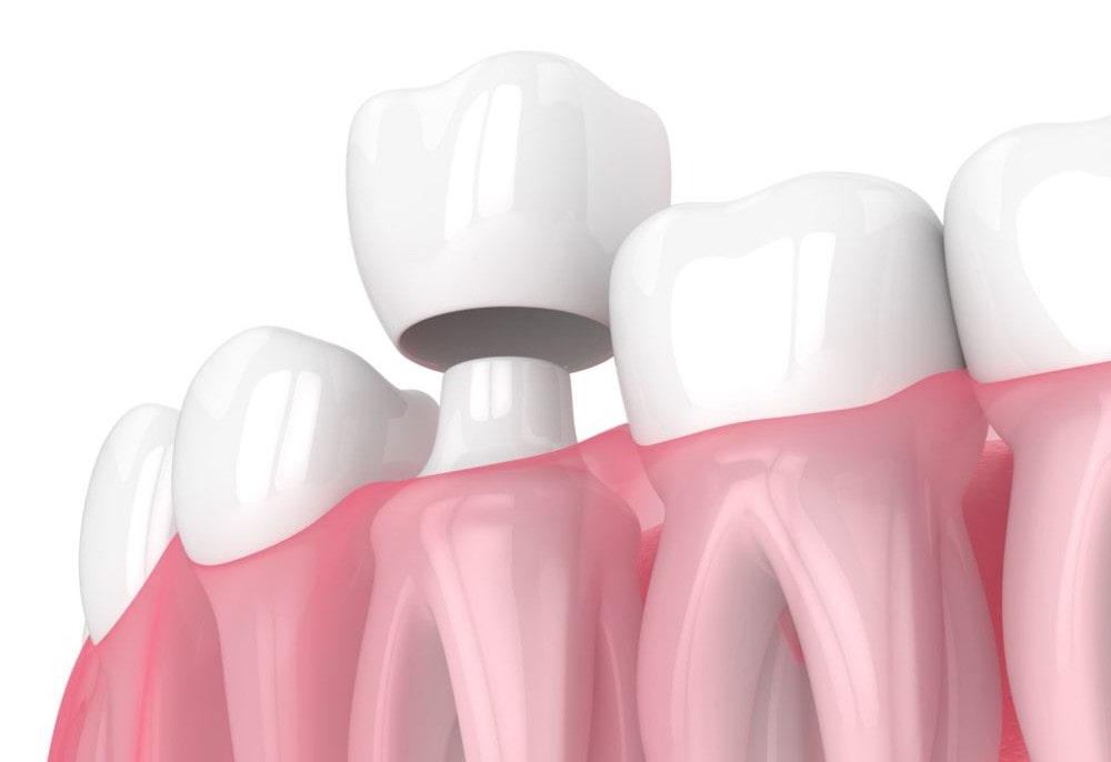 Dental Crown Procedure