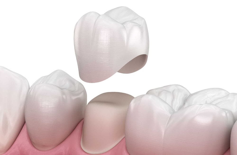 What are dental crowns