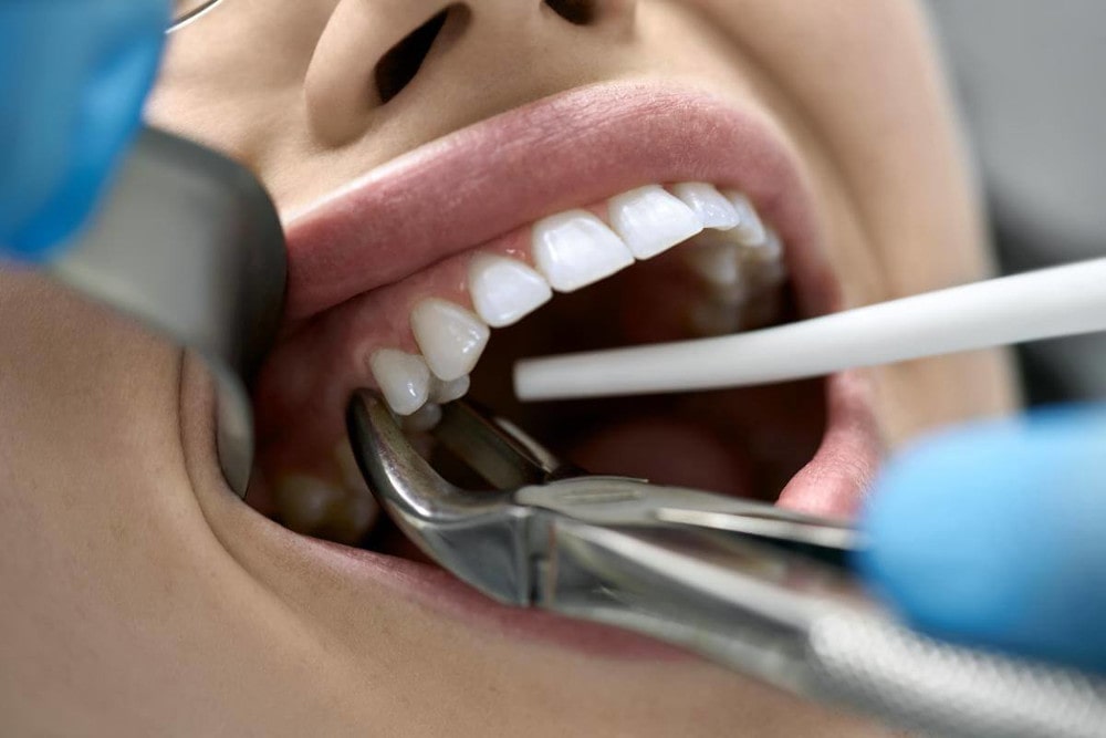 cost of tooth extraction in Toronto 