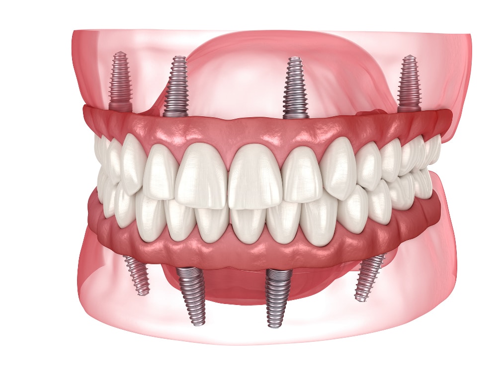 Teeth-In-A-Day